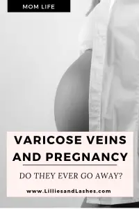 Varicose Veins and Pregnancy